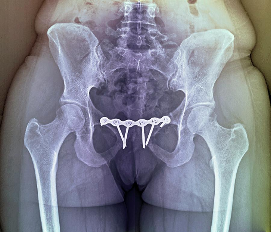 pinned-pelvic-fracture-photograph-by-zephyr-science-photo-library