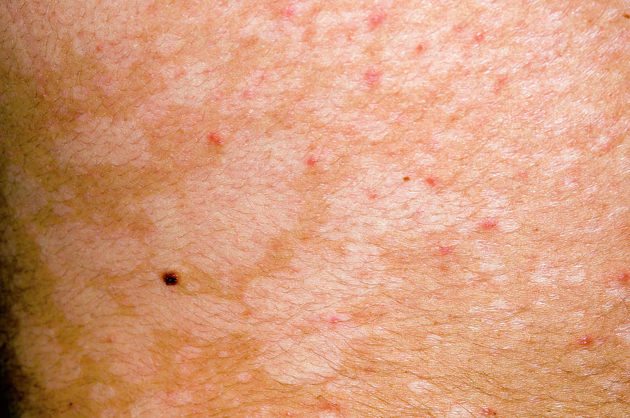 pityriasis-versicolor-skin-infection-photograph-by-dr-p-marazzi