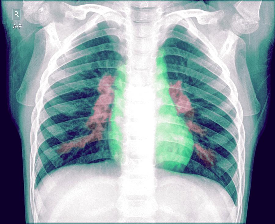 Pneumonia #1 Photograph by Photostock-israel