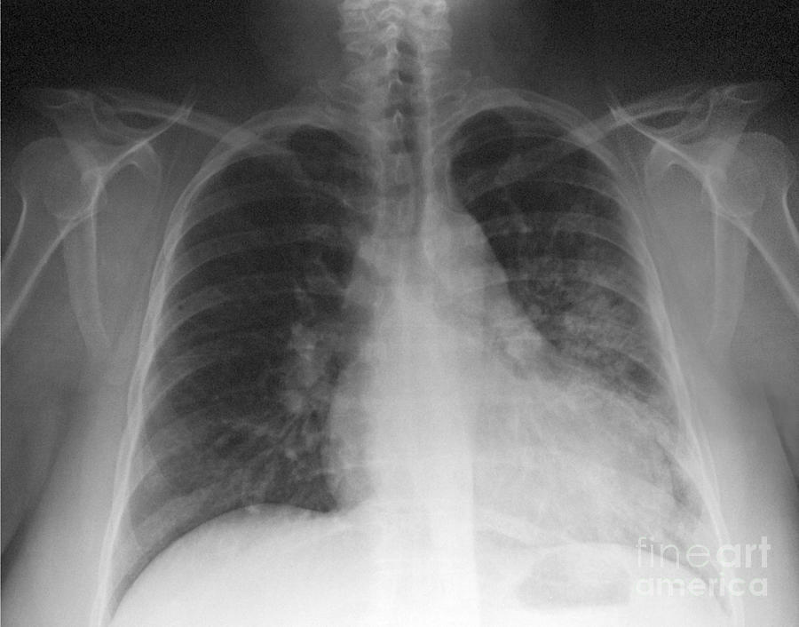 X Ray Photograph - Pneumonia, X Ray #1 by Scott Camazine