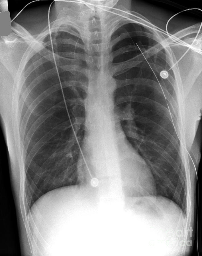 Pneumothorax Treatment, X-ray Photograph by Du Cane Medical Imaging Ltd.