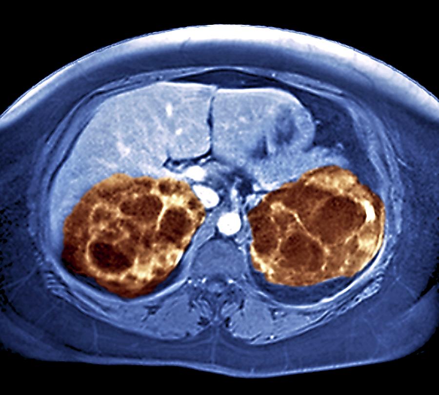 Polycystic Kidneys Photograph by Zephyr/science Photo Library - Fine ...