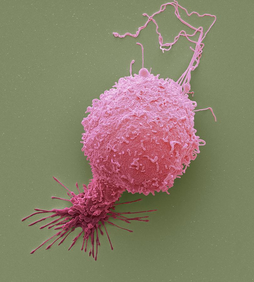 Prostate Cancer Cell Photograph by Steve Gschmeissner - Fine Art America