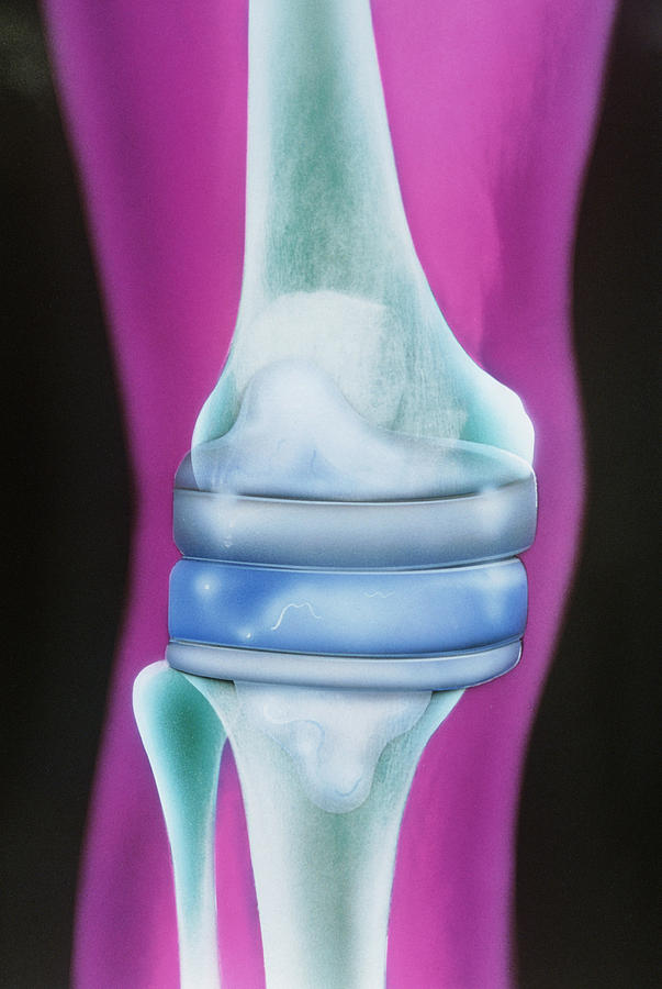 Prosthetic Knee #1 Photograph by Chris Bjornberg