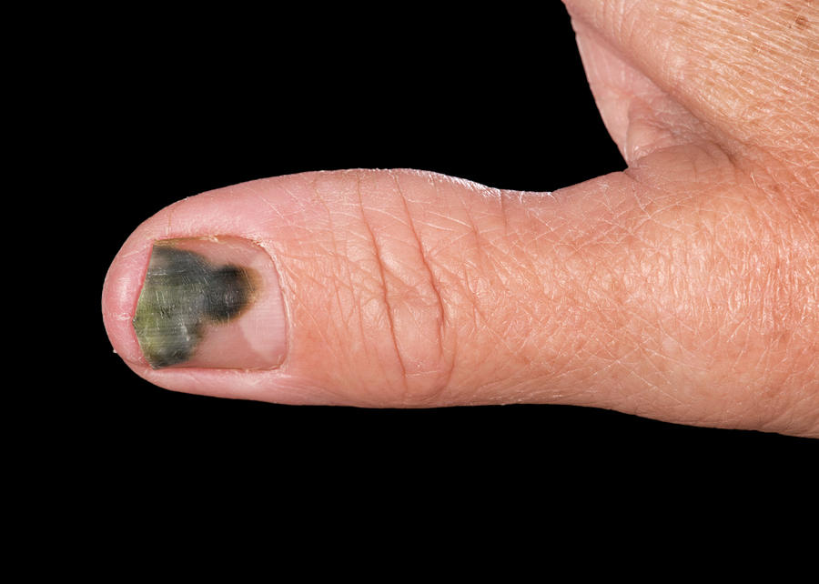 Pseudomonas Bacterial Nail Infection Photograph By Mid Essex Hospital Services Nhs Trust Science