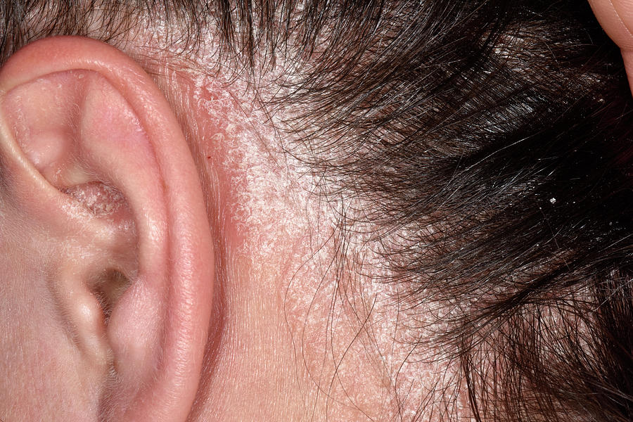 Psoriasis On The Scalp Photograph By Dr P Marazzi Science Photo Library