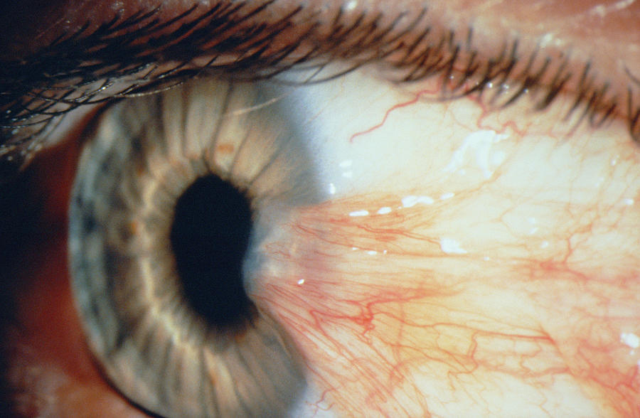 Pterygium Of The Eye Photograph by Paul Parker/science Photo Library ...