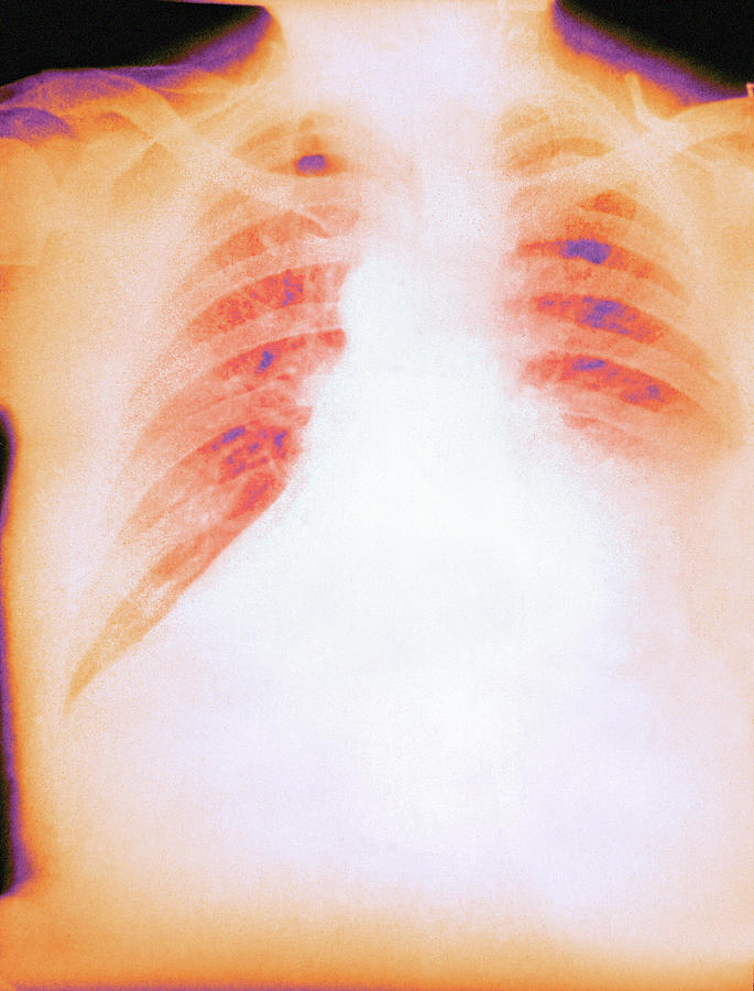 Pulmonary Anthrax 1 Photograph By Cdcscience Photo Library Pixels 9004