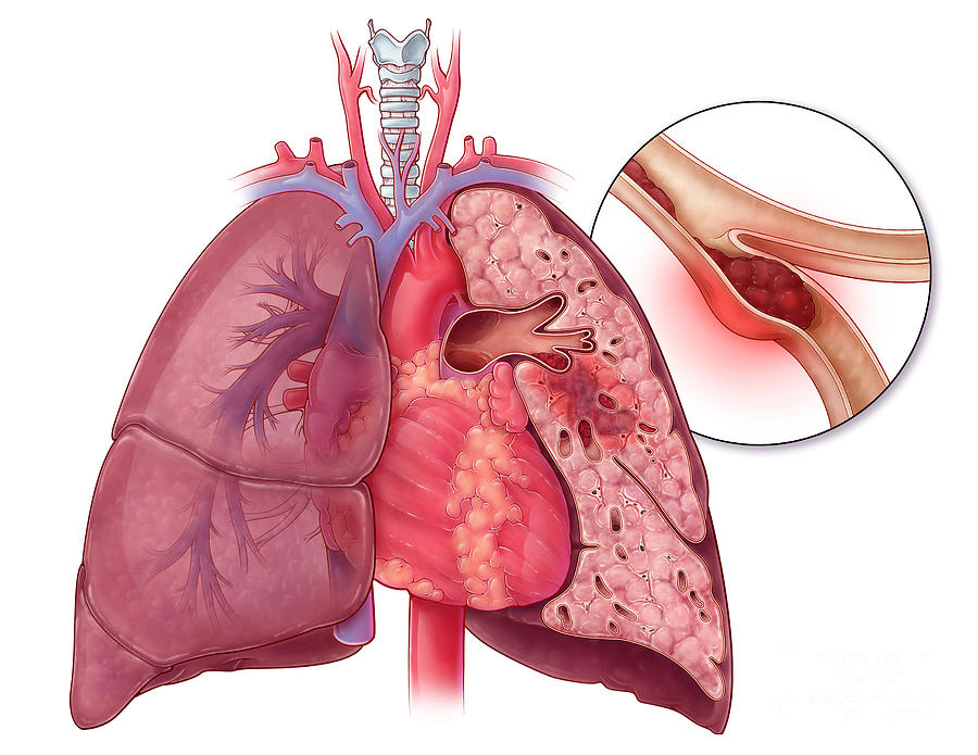 Pulmonary Embolism, Illustration Photograph by Evan Oto - Fine Art America