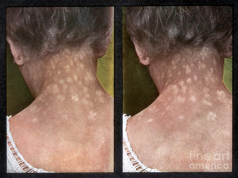 Rash Caused By Syphilis, Vintage #1 Photograph by DoubleVision