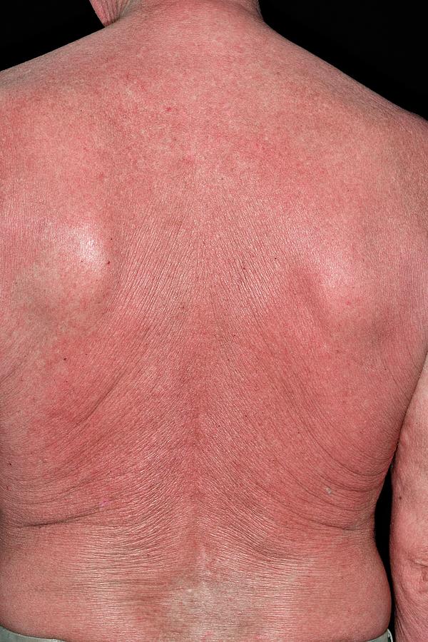 1 Rash On Back After Cancer Treatment Dr P Marazziscience Photo Library 