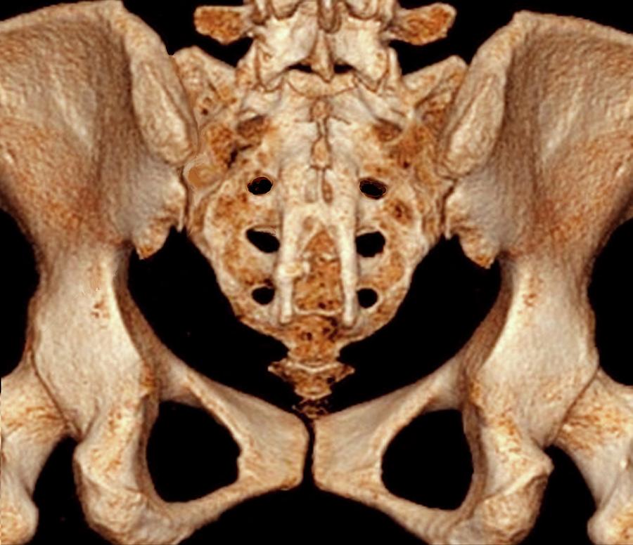 Pelvis Photograph - Rear Of Pelvis And Base Of Spine #1 by Zephyr/science Photo Library
