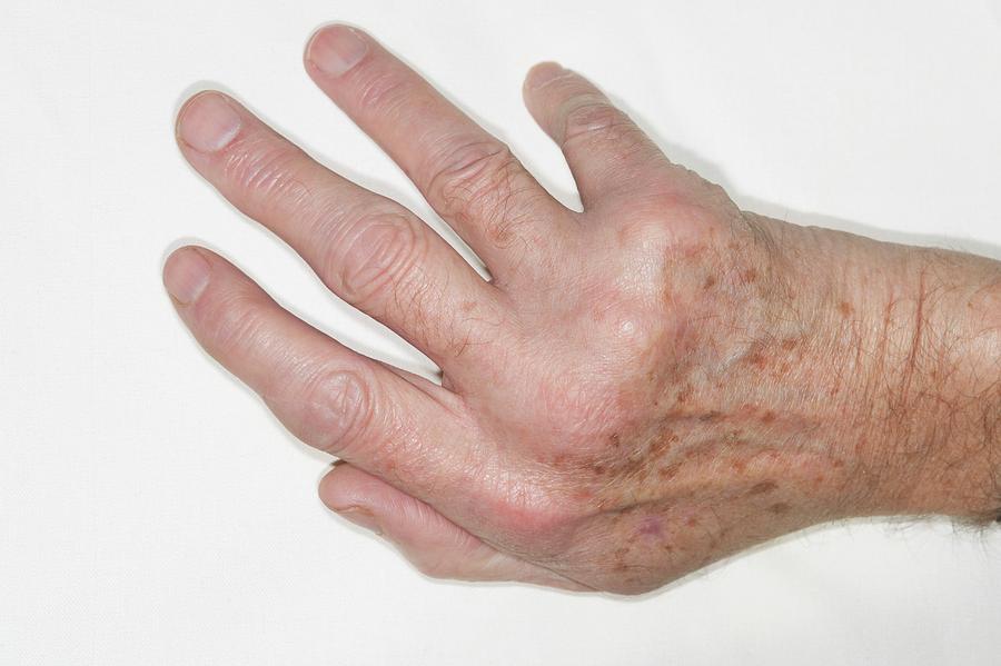 Rheumatoid Arthritis Of The Hand Photograph By Dr P Marazziscience