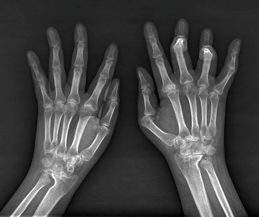 Rheumatoid Arthritis Photograph - Rheumatoid Arthritis Of The Hands #1 by Zephyr/science Photo Library