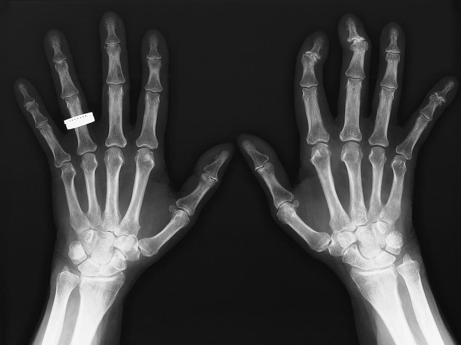 Rheumatoid Arthritis Photograph By Zephyr/science Photo Library | Fine ...