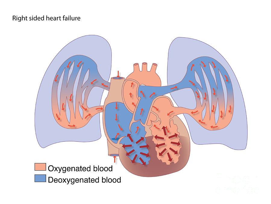 Right-sided Heart Failure, Artwork Photograph by Peter Gardiner