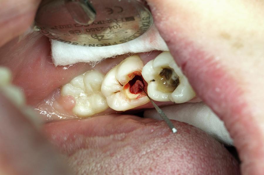 molar root canal