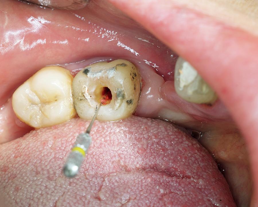 Root Canal Surgery Photograph by Dr Armen Taranyan / Science Photo Library