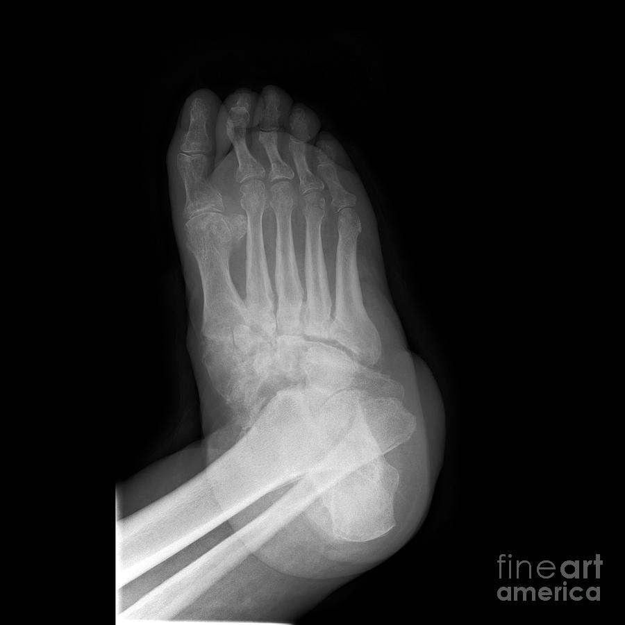 Salter Harris Fracture, X-ray Photograph by Science Photo Library ...