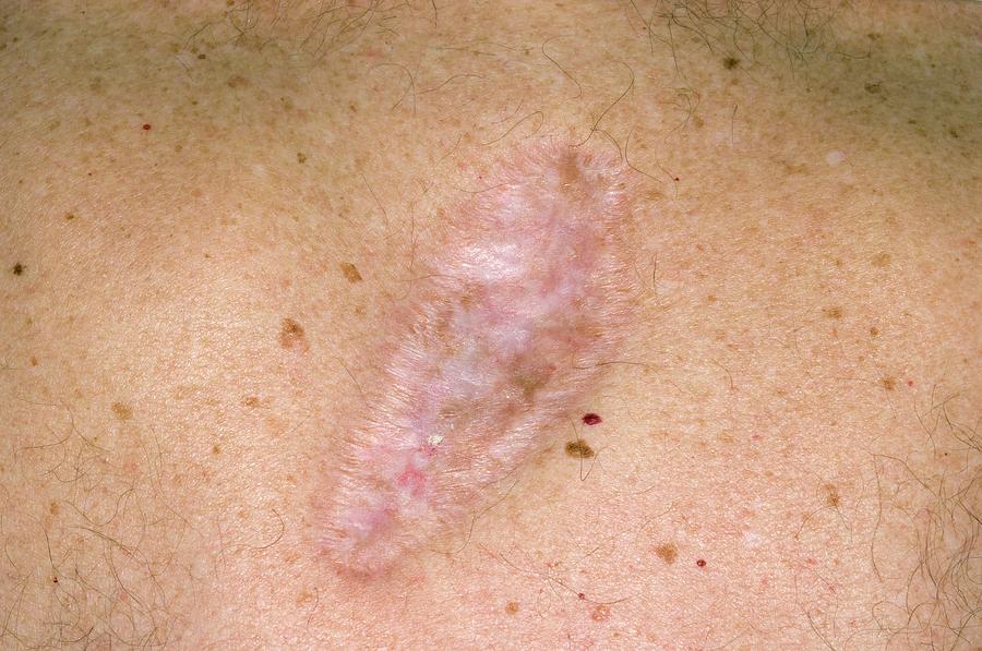 Scar On The Skin After Cancer Removal Photograph By Dr P Marazzi
