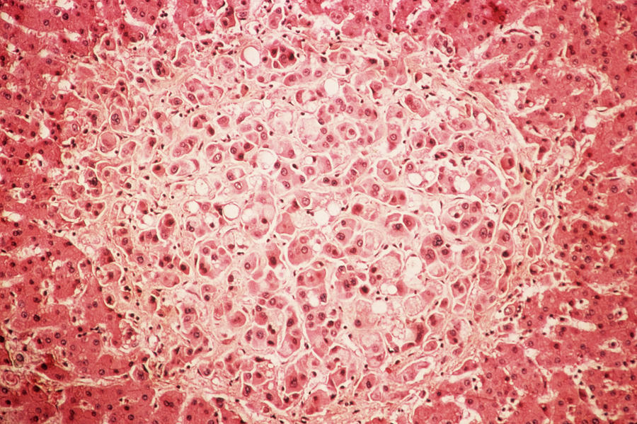 Secondary Liver Cancer #1 Photograph by Cnri/science Photo Library