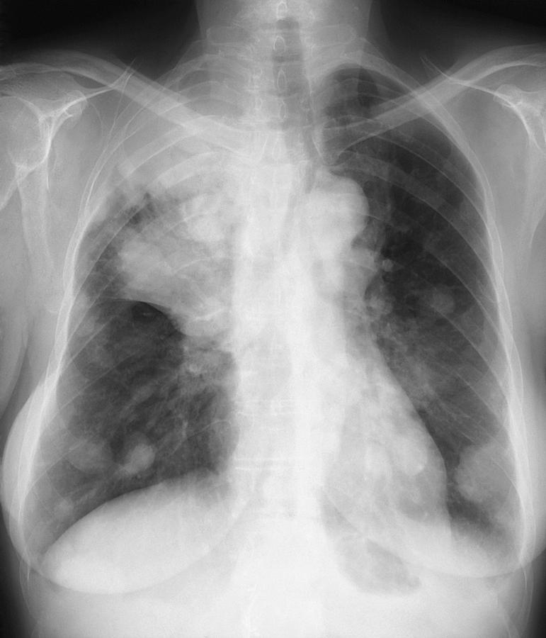 Black And White Photograph - Secondary lung cancer, X-ray #1 by Science Photo Library