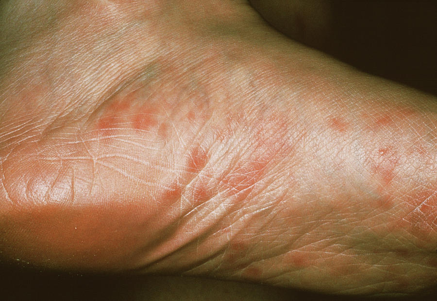 hiv-rash-on-feet