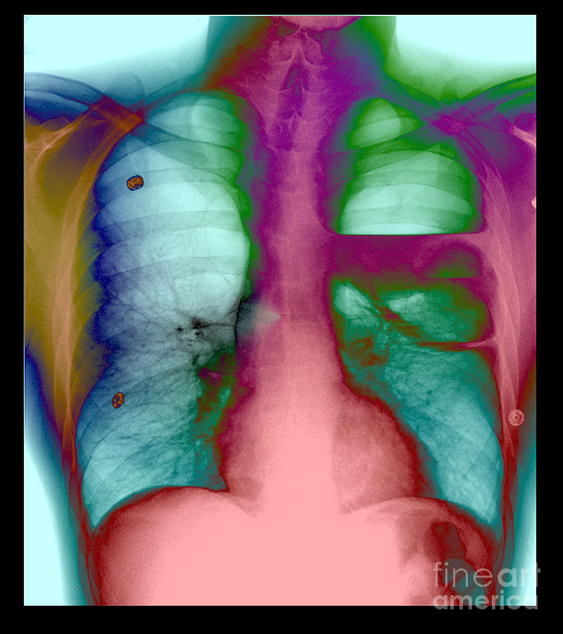 Chest X-ray Photograph - Severe Bullous Emphysema #1 by Living Art Enterprises, LLC