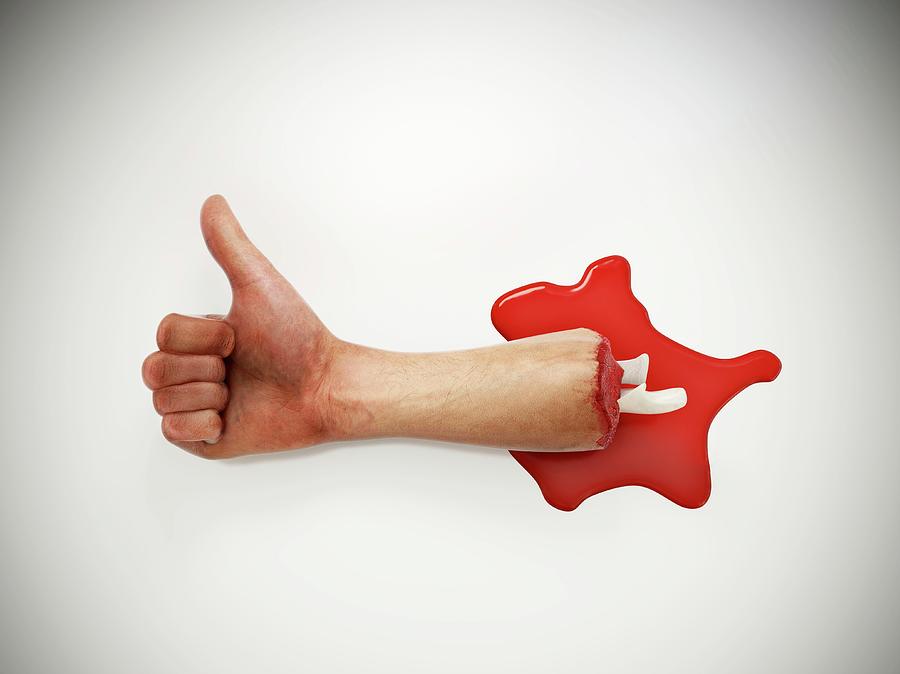 Severed Arm #1 Photograph by Andrzej Wojcicki/science Photo Library