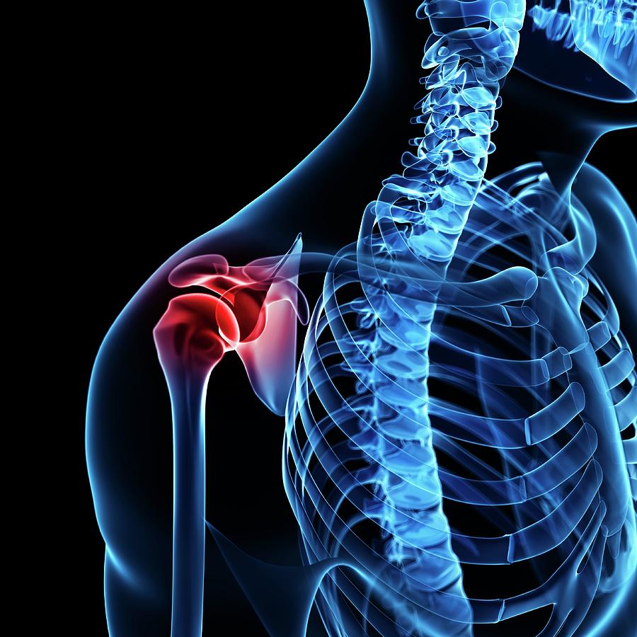 Shoulder Pain Photograph by Sciepro/science Photo Library