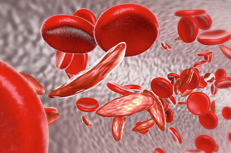 Sickle Cell Anaemia Photograph By Kateryna Kon Science Photo Library Pixels