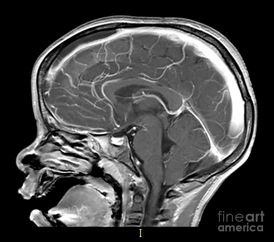 Head Photograph - Sinusitis With Subdural And Epidural #1 by Living Art Enterprises