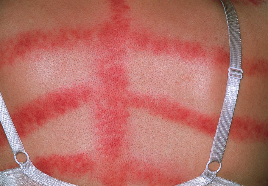 Skin Allergy Photograph by Dr P. Marazzi/science Photo Library