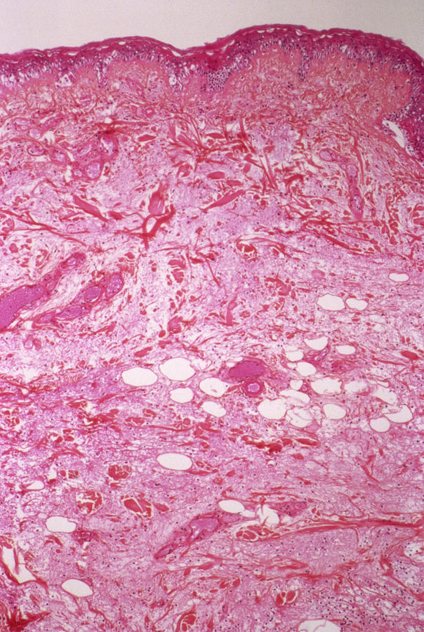 Skin Tumour Photograph by Cnri/science Photo Library - Fine Art America