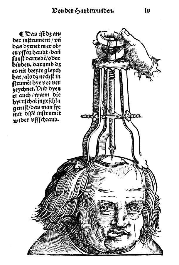 Skull Operation, 1517 #1 Photograph by Granger
