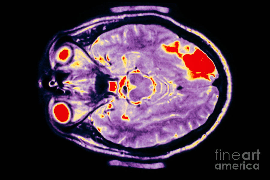 Skull Showing Region Of Stroke In Brain #1 Photograph by Lunagrafix