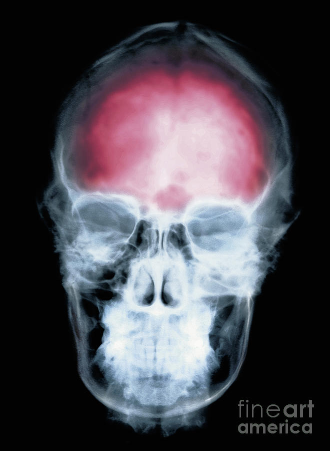 Skull Photograph - Skull X-ray #1 by Erich Schrempp