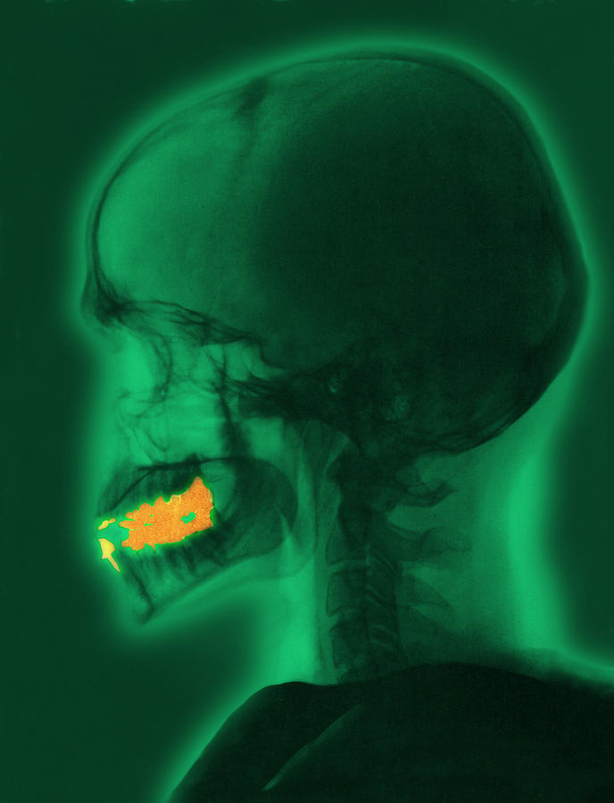 Skull X-ray With Dental Fillings #1 Photograph by Science Source