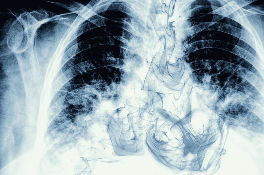 Smoke visible on chest X-ray image #1 Photograph by GM Stock Films