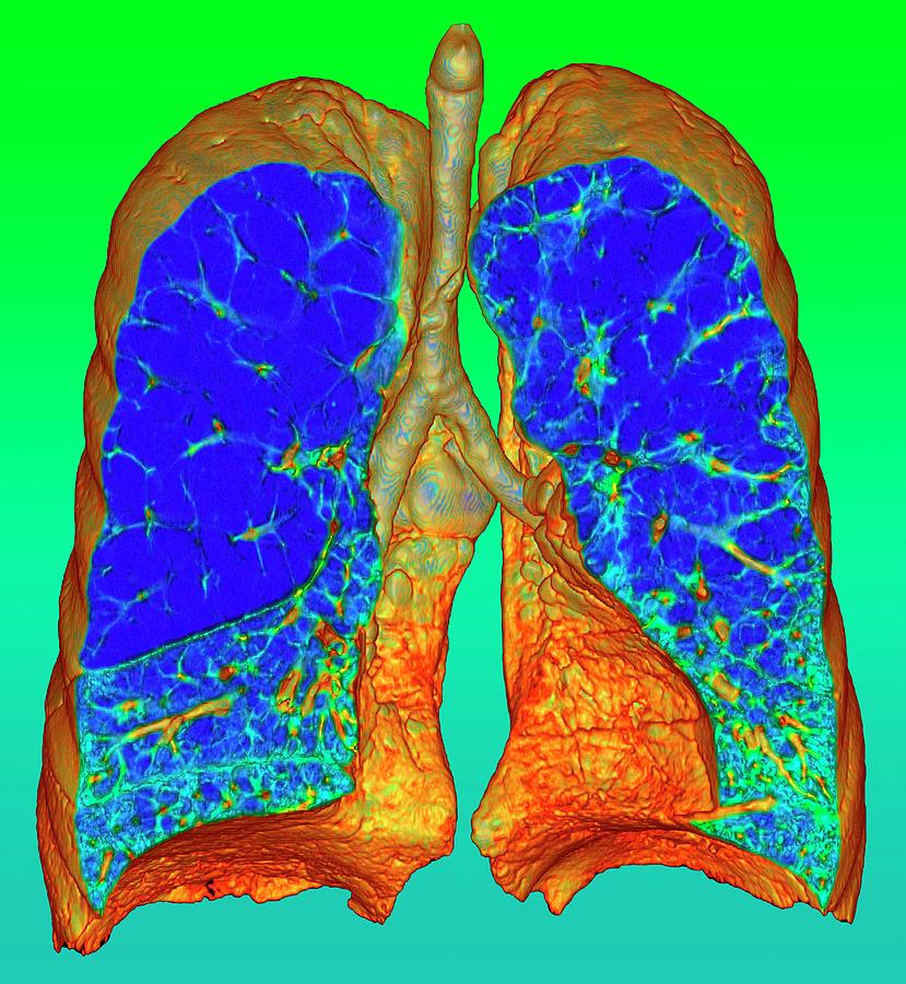 Emphysema Lungs
