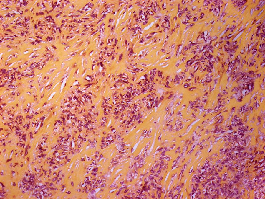 Smooth Muscle Cancer #1 Photograph by Steve Gschmeissner
