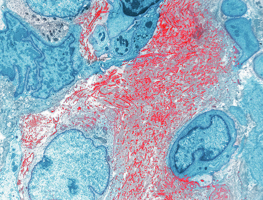 Soft Tissue Sarcoma Photograph by National Cancer Institute/science ...