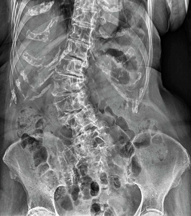 spinal Curvature (scoliosis) #1 Photograph by Zephyr/science Photo Library