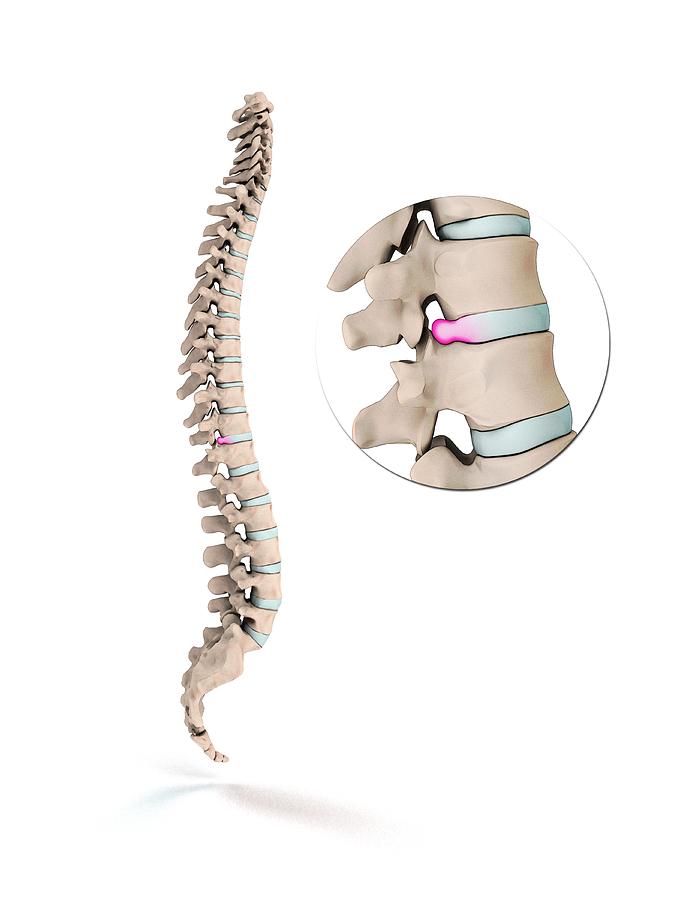 Spinal Disc Prolapse Photograph by Mikkel Juul Jensen