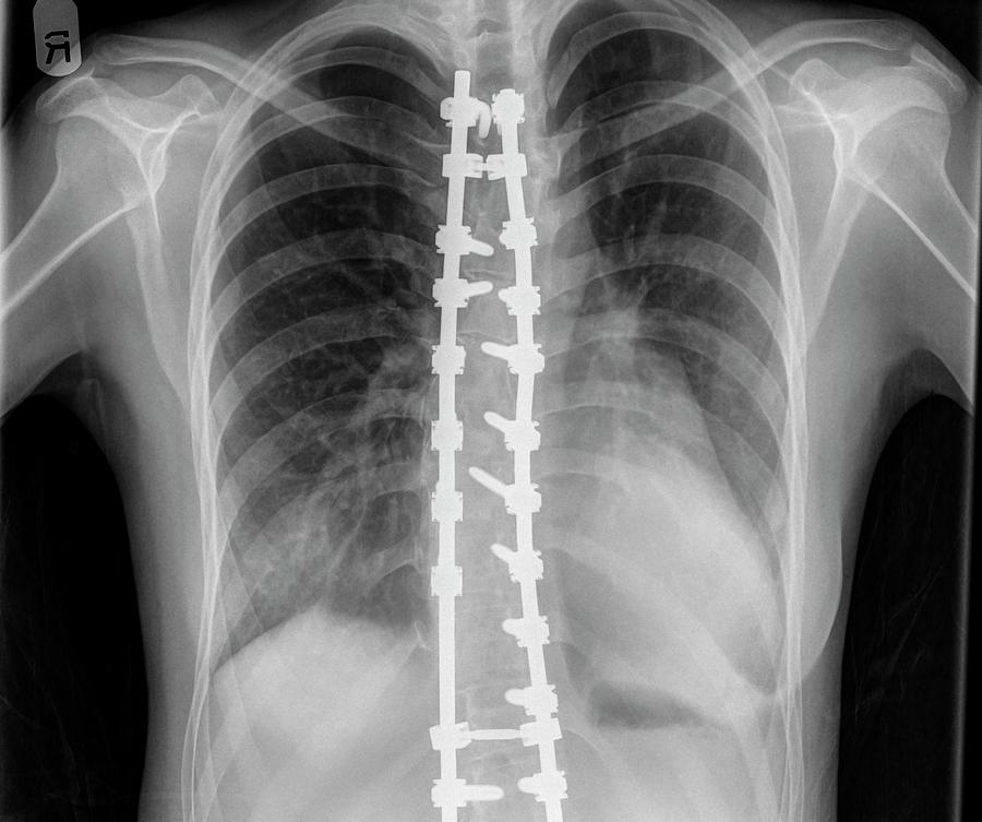 Skeleton Photograph - Spinal Fusion #1 by Photostock-israel
