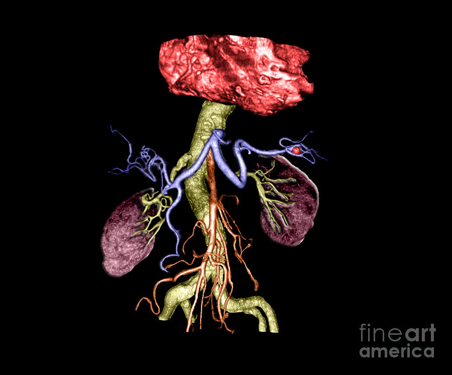 Splenic Artery Aneurysm #1 Photograph by Living Art Enterprises, LLC
