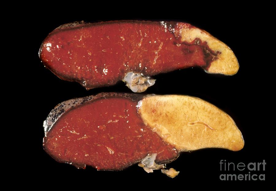 Splenic Infarct Photograph by Cnri | Fine Art America