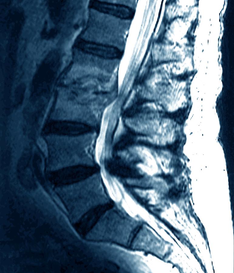 Spondylitis Of Spine #1 Photograph By Zephyr/science Photo Library ...