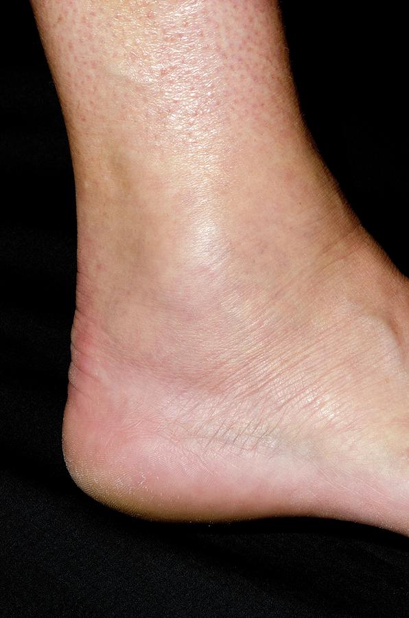 Sprained Ankle Photograph By Dr P Marazzi Science Photo Library My XXX Hot Girl