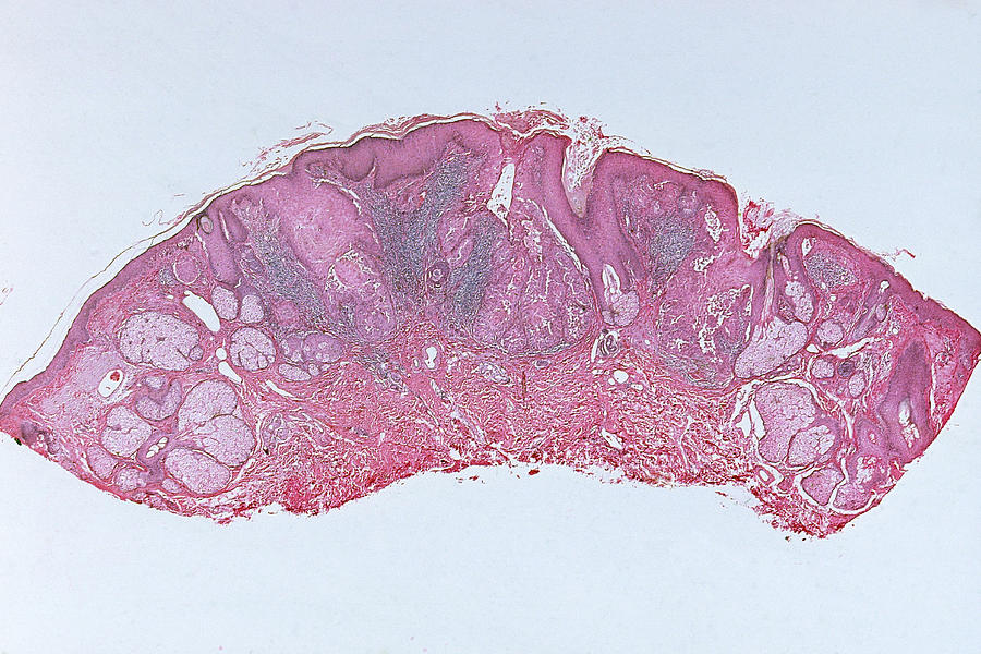 Squamous Cell Carcinoma, Lm #1 Photograph by Michael Abbey
